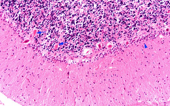 2B2 Vitamin E Deficiency (Biliary atresia, Case 2) Cerebellum H&E 1 copy A copy