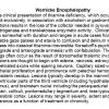 0A Wernicke Encephalopathy - Text