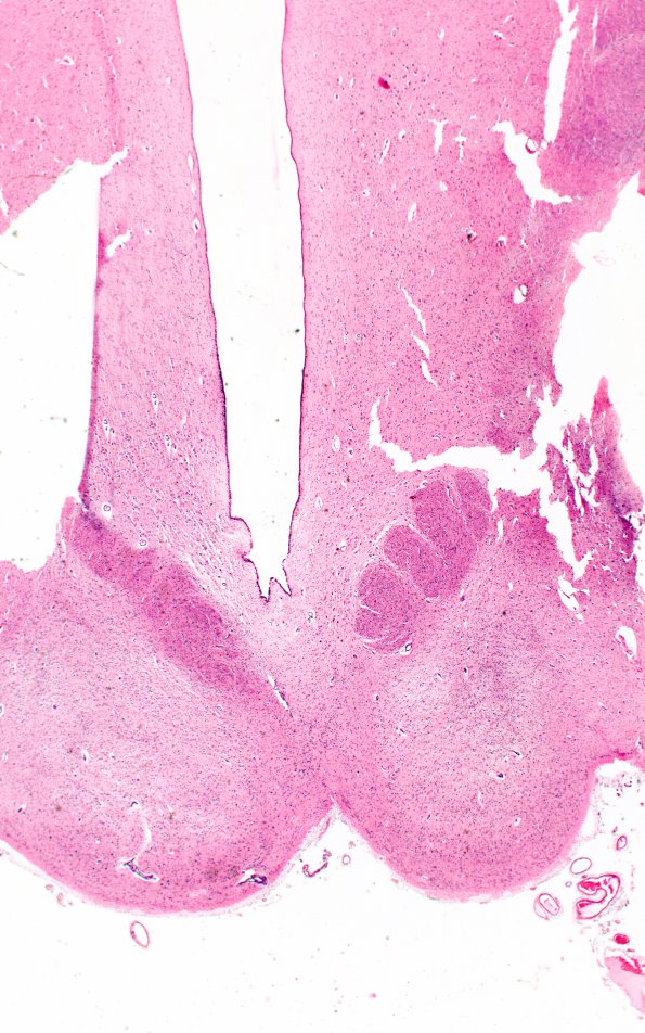 10A Wernicke's Encephalopathy (Case 10) H&E 1