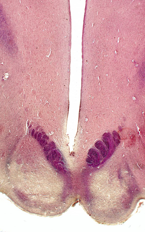 10A2 Wernicke Encephalopathy (Case 10) 1 Trichrome