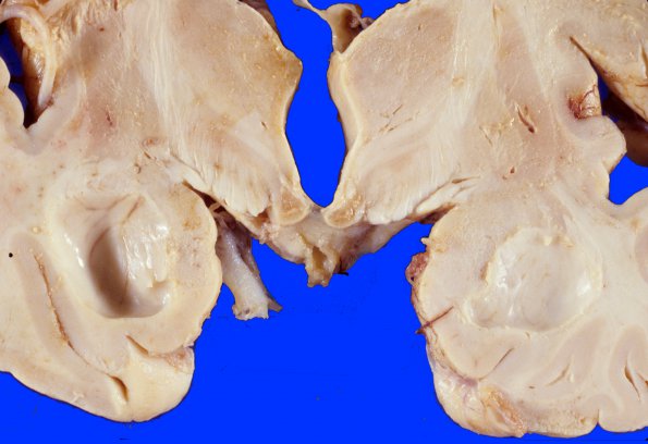 11 Wernike encephalopathy (Case 11)