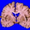 12A1 Wernicke Encephalopathy (Case 12) 2