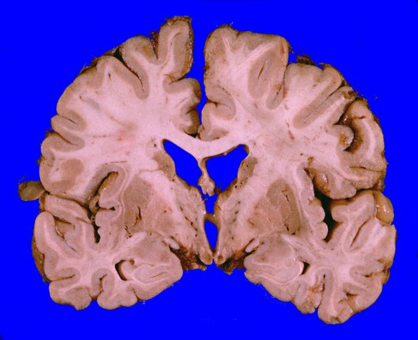 12A1 Wernicke Encephalopathy (Case 12) 2