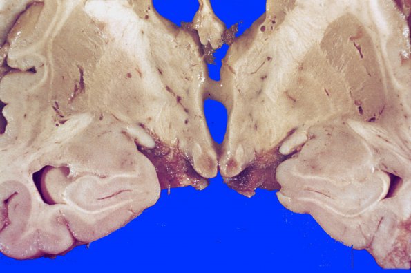 12A2 Wernicke Encephalopathy (Case 12) 2