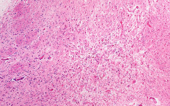 12B1 Wernicke Encephalopathy (Case 12) H&E 3