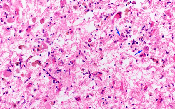 12B3 Wernicke Encephalopathy (Case 12) H&E 1 copy