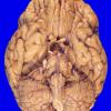 13A1 Wernicke Encephalopathy (Case 13) copy A