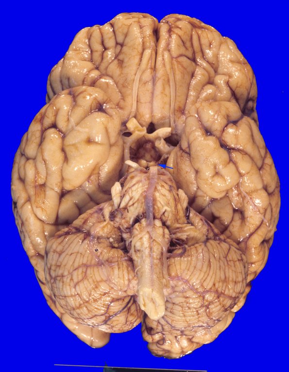 13A1 Wernicke Encephalopathy (Case 13) copy A