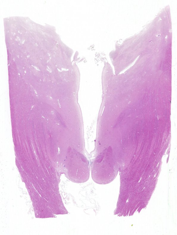 13B1 Wernicke encephalopathy Thal & MB (Case 13) H&E N11 whole mount