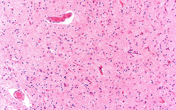 13B2 Wernicke encephalopathy MB (Case 13) H&E N11 MB 4