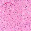 13B3 Wernicke encephalopathy MB (Case 13) H&E N11 MB 2