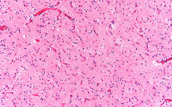 13B3 Wernicke encephalopathy MB (Case 13) H&E N11 MB 2