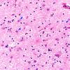 13B4 Wernicke encephalopathy MB (Case 13) H&E N11 MB 3 copy