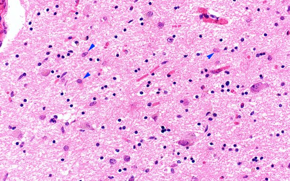 13B4 Wernicke encephalopathy MB (Case 13) H&E N11 MB 3 copy