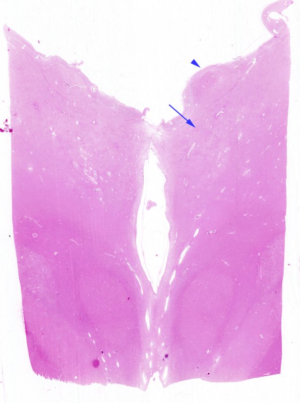 13C1 Wernicke encephalopathy Thalamus (Case 13) H&E N13 whole mount copy A