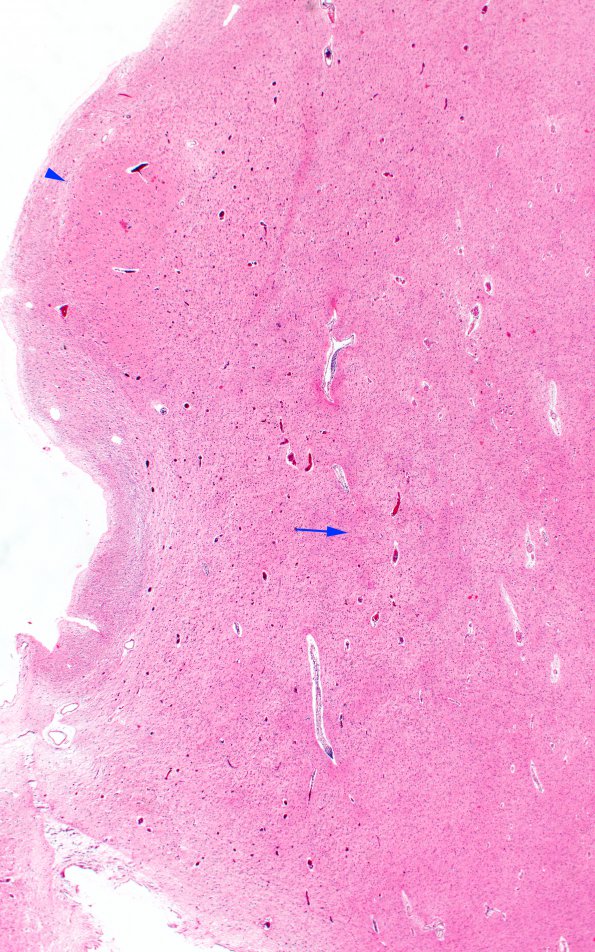 13C2 Wernicke encephalopathy Thalamus (Case 13) H&E N13 2x ant & dorsomedian copy