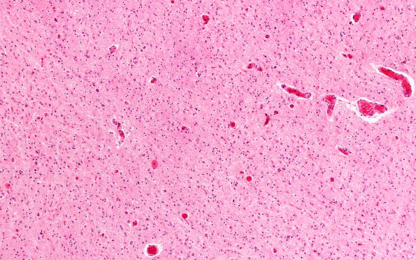 13C3 Wernicke encephalopathy Thalamus (Case 13) H&E N13 4x ant & dorsomedian