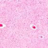 13C6 Wernicke Encephalopathy (Case 13) H&E N4 thalamus H&E 2