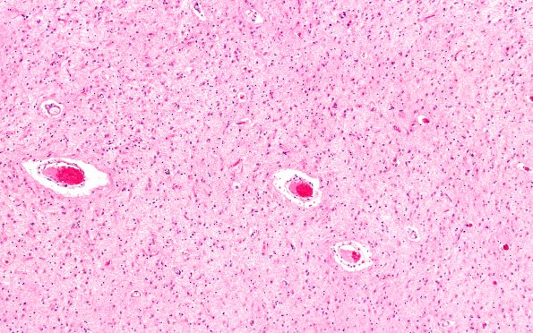 13C6 Wernicke Encephalopathy (Case 13) H&E N4 thalamus H&E 2