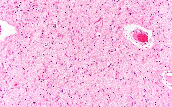 13C7 Wernicke Encephalopathy (Case 13) H&E N4 thalamus H&E 1