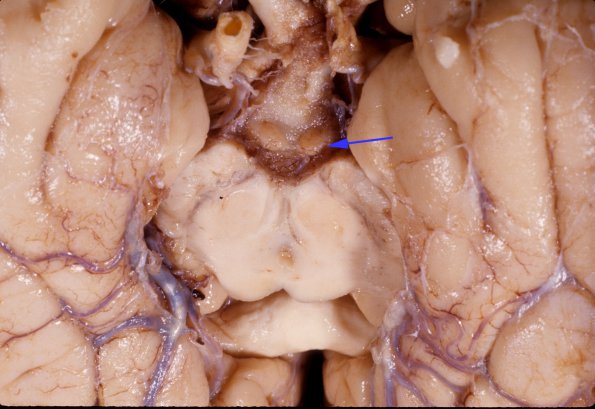 14A1 Wernicke's Encephalopathy (Case 14) 1 copy