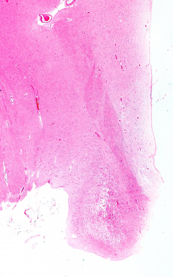 14B1 Wernicke's Encephalopathy (Case 14) H&E 7 A