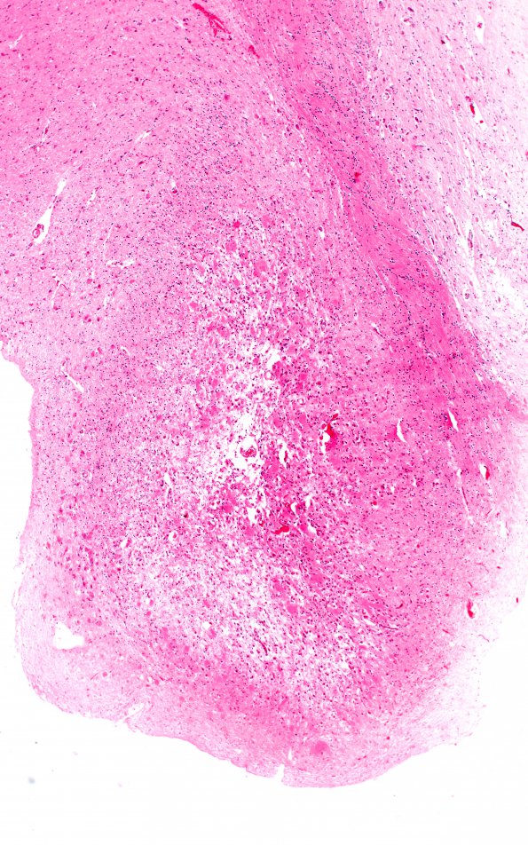 14B2 Wernicke's Encephalopathy (Case 14) H&E 7