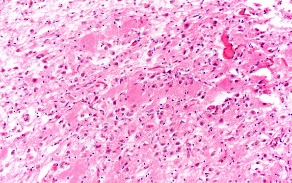 14B3 Wernicke's Encephalopathy (Case 14) H&E 7