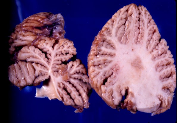 15A2 Wernicke's Encephalopathy Pattern (Case 15) A