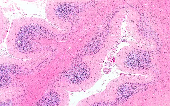 15B1 Question Wernicke's Encephalopathy Pattern Cerebellum (Case 15) H&E 2