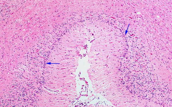 15B2  Question Wernicke's Encephalopathy Pattern Cerebellum (Case 15) H&E 1 copy