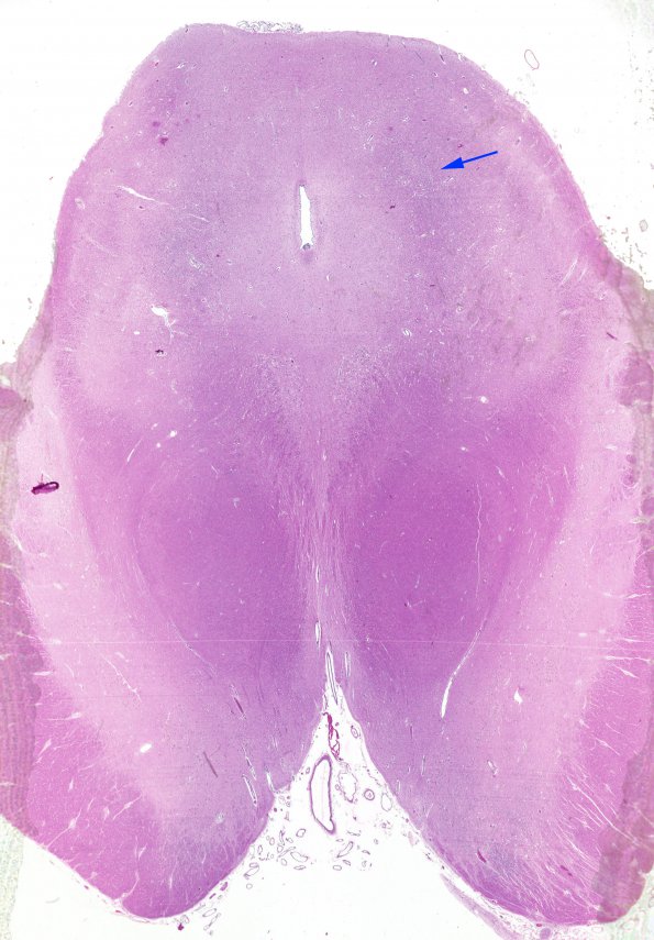 16A1 Wernicke Encephalopathy (Case 16) midbrain 1 copy