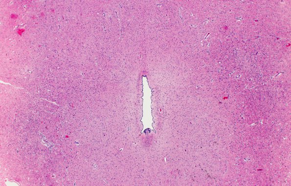 16A2 Wernicke Encephalopathy (Case 16) midbrain H&E 3