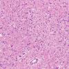 16A3 Wernicke Encephalopathy (Case 16) midbrain H&E 2