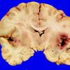 17A1 Wernicke Syndrome (Case 17) Yellow _3