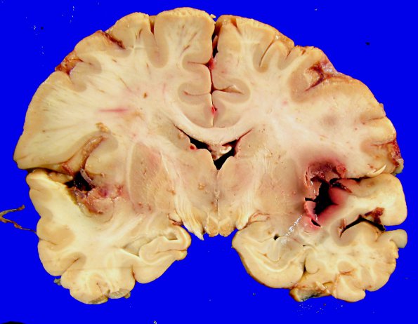 17A1 Wernicke Syndrome (Case 17) Yellow _3