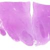 17B1 Wernicke syndrome (Case 17) N13 H&E WM