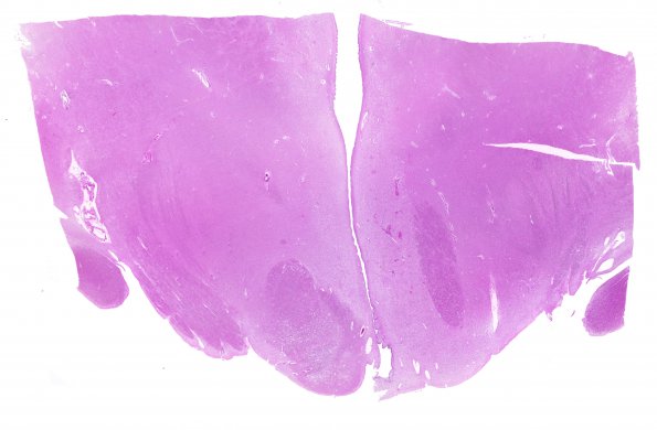 17B1 Wernicke syndrome (Case 17) N13 H&E WM