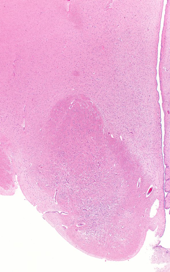 17B2 Wernicke syndrome (Case 17) N13 H&E 2X