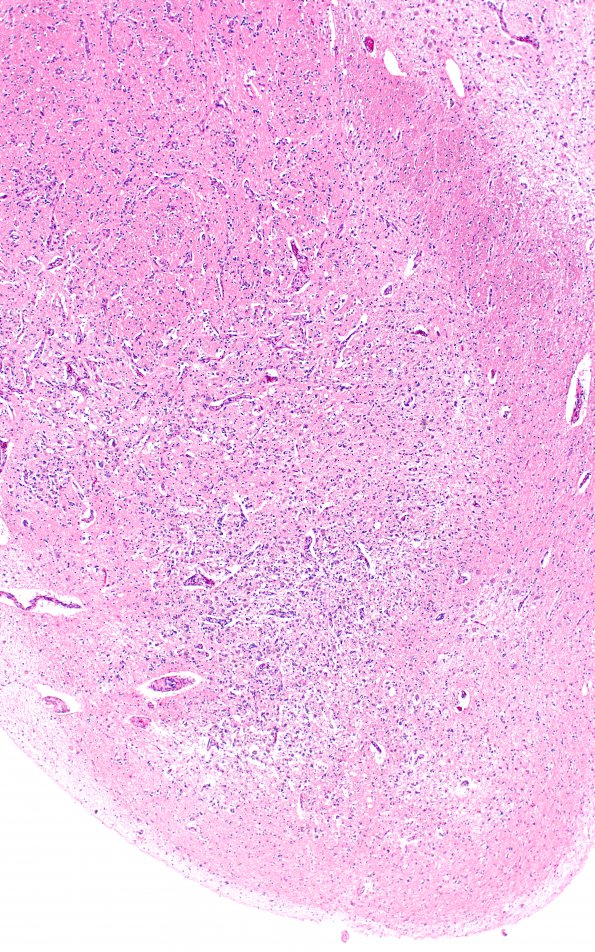 17B3 Wernicke syndrome (Case 17) N13 H&E 4X