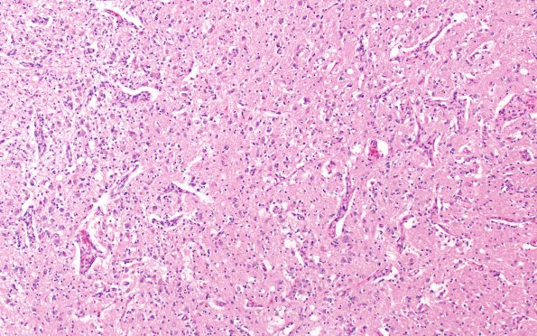 17B4 Wernicke syndrome (Case 17) N13 H&E 10X