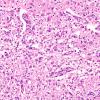 17B5 Wernicke syndrome (Case 17) N13 H&E 20X