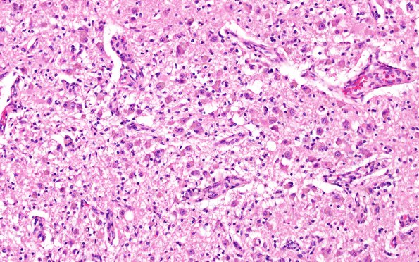 17B5 Wernicke syndrome (Case 17) N13 H&E 20X