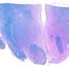 17C1 Wernicke syndrome (Case 17) N13 LFB=PAS WM