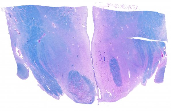 17C1 Wernicke syndrome (Case 17) N13 LFB=PAS WM