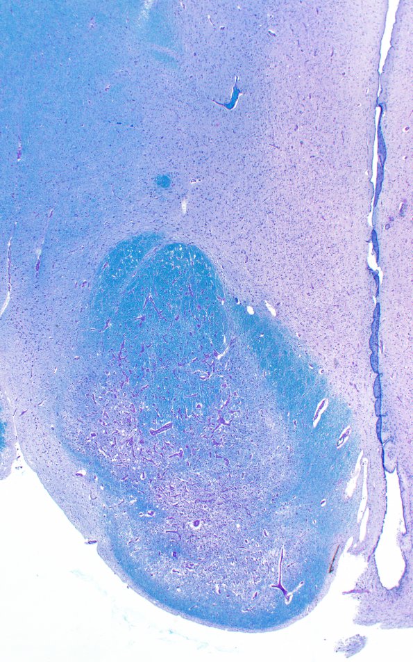 17C2 Wernicke syndrome (Case 17) N13 LFB-PAS 2X