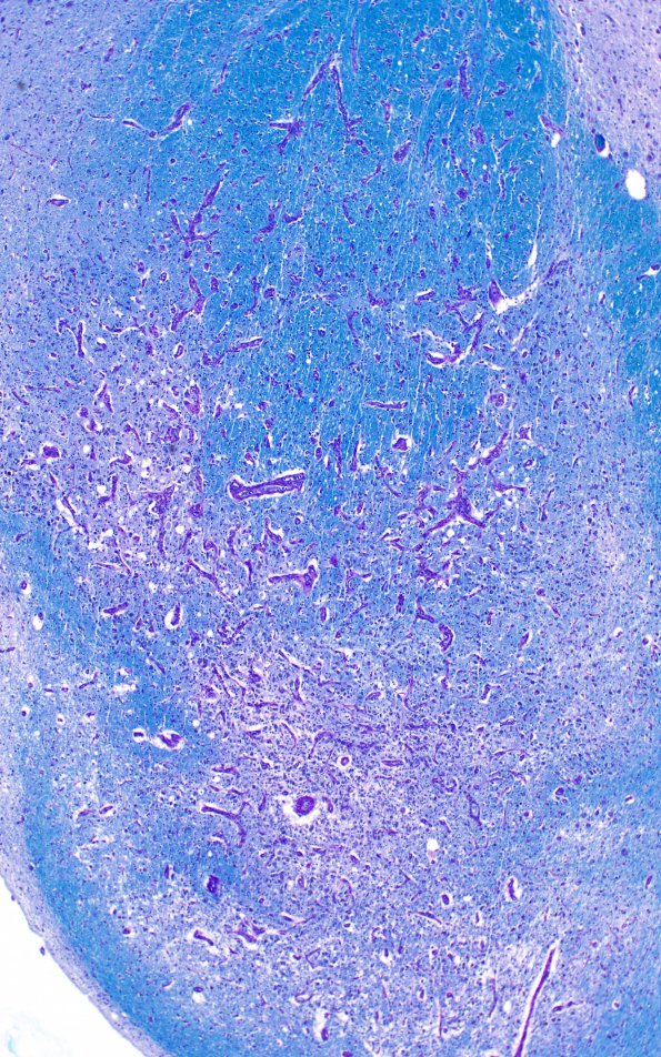 17C3 Wernicke syndrome (Case 17) N13 LFB-PAS 4X