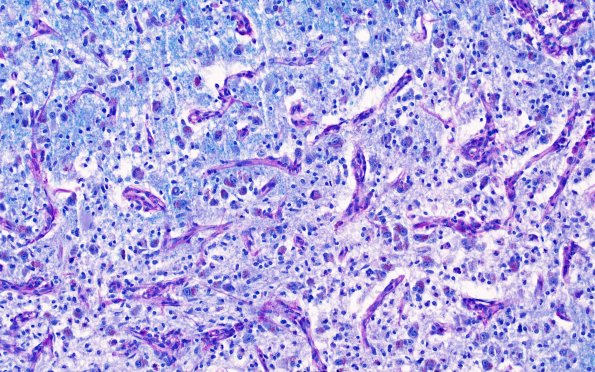 17C4 Wernicke syndrome (Case 17) N13 LFB-PAS 20X