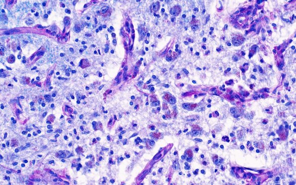 17C5 Wernicke syndrome (Case 17) N13 LFB-PAS 40X