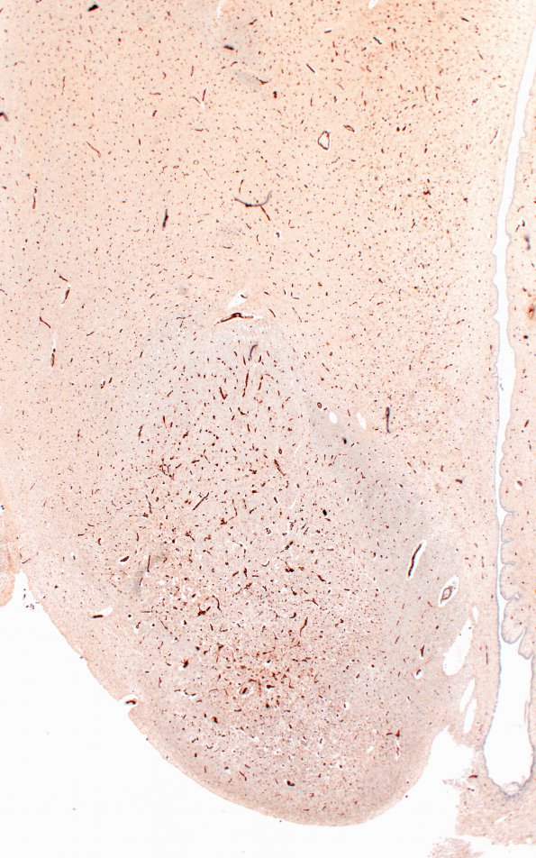 17D2 Wernicke syndrome (Case 17) N13 CD31 2X 2